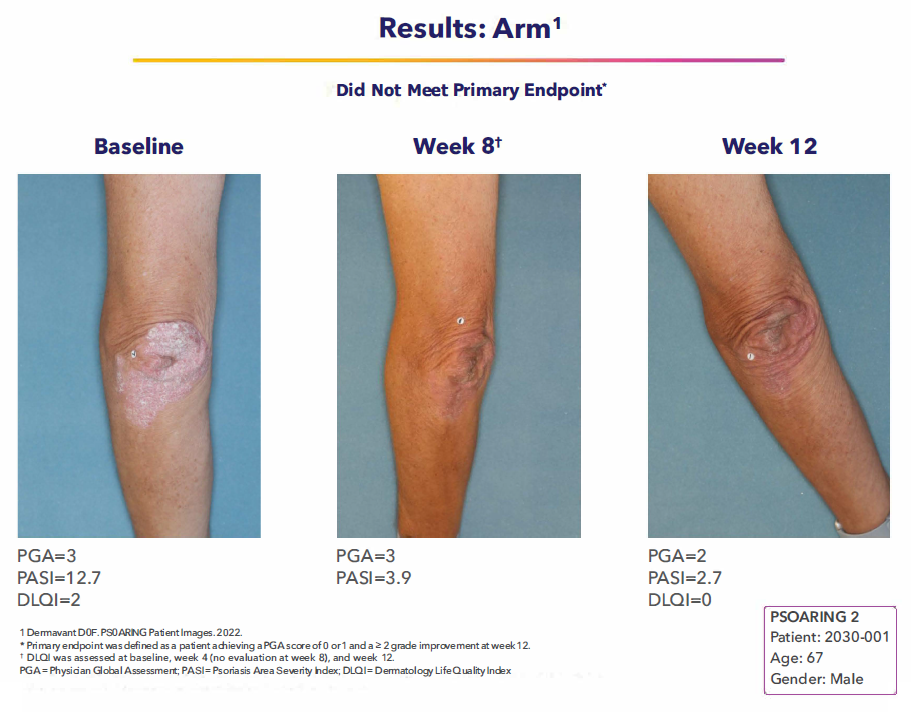 Tapinarof Cream 1% is FDA Approved